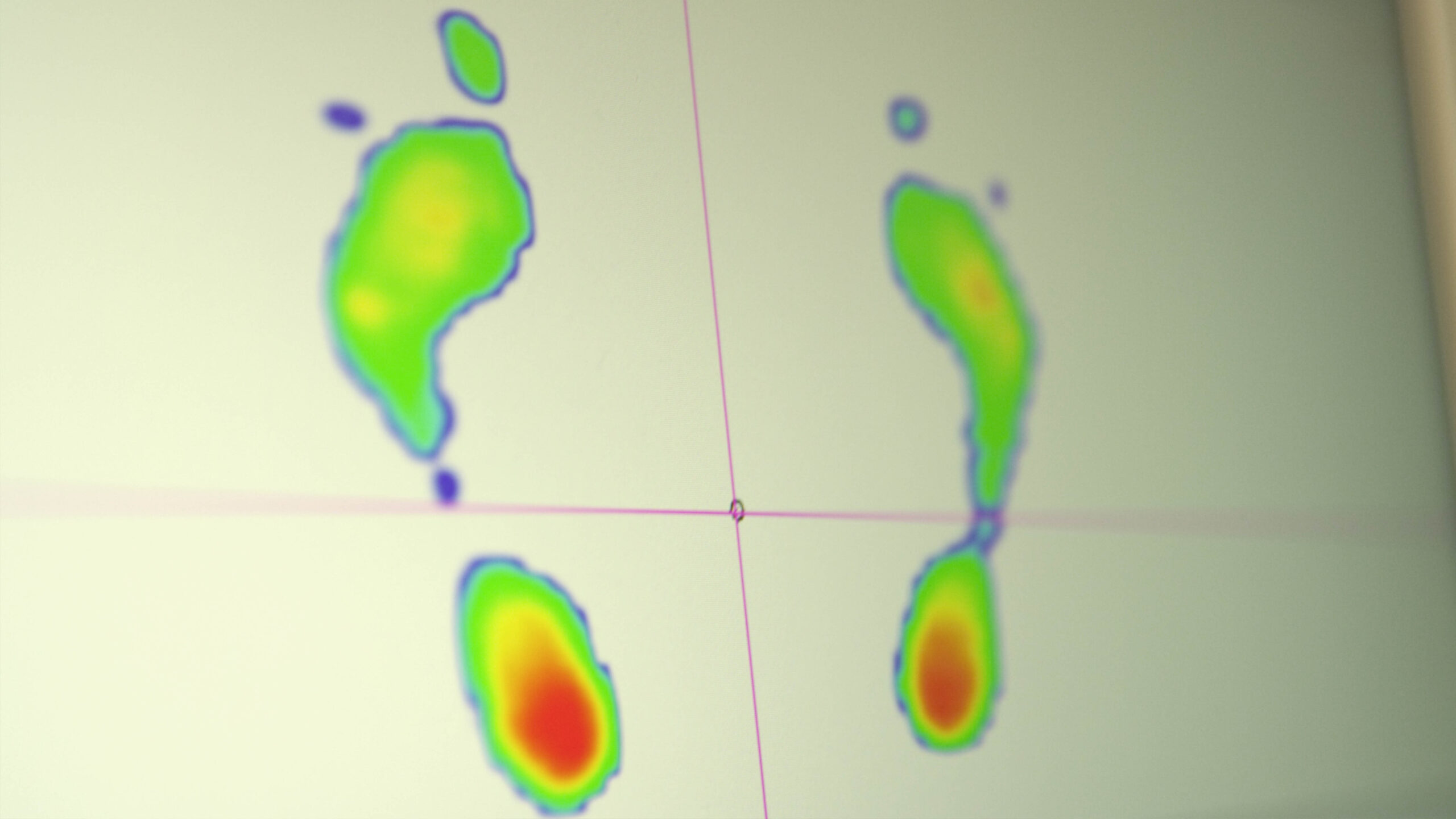 Gait analysis - Burgess Hill | Nimbus Clinics